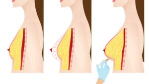 lipofilling-mammaire-tunisie